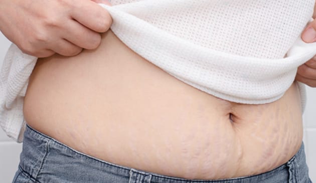 Stretch marks