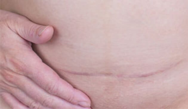 C section scar