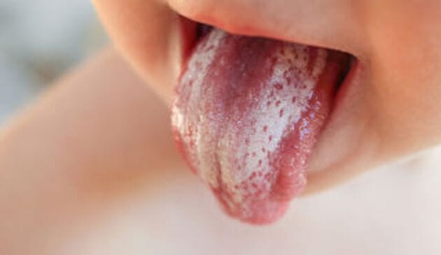 Babies tongue with thrush